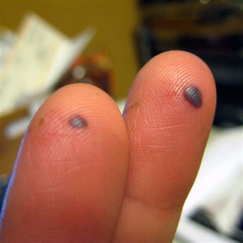 Pictures of Blood Blisters: Understanding Causes, Treatment, and ...