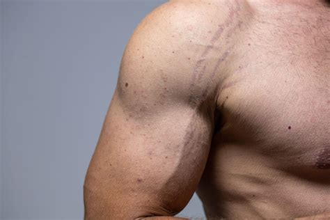 Stretch Marks Men Removal
