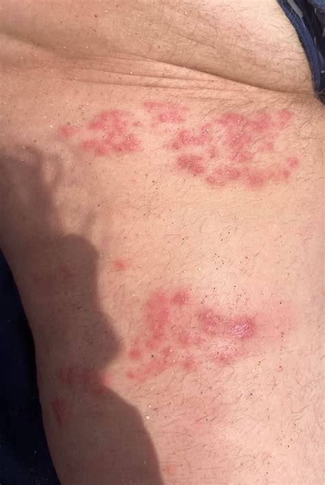 Any idea what could this be? It’s a couple months old, doesn’t disappear and steroid cream didn ...