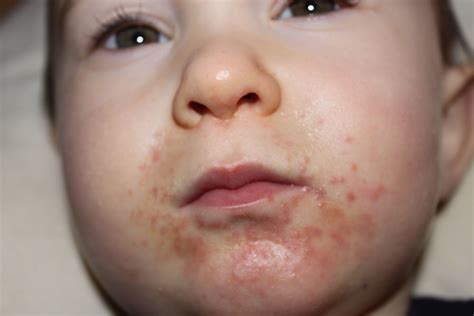Rash Around Toddlers' Mouth - New Kids Center | Rashes in children ...