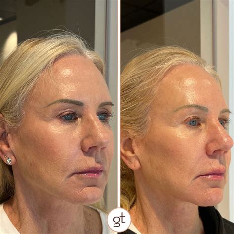 Before and After Gallery Dermal Fillers - Stunning Transformations