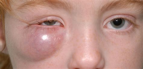 Cellulitis Treatment