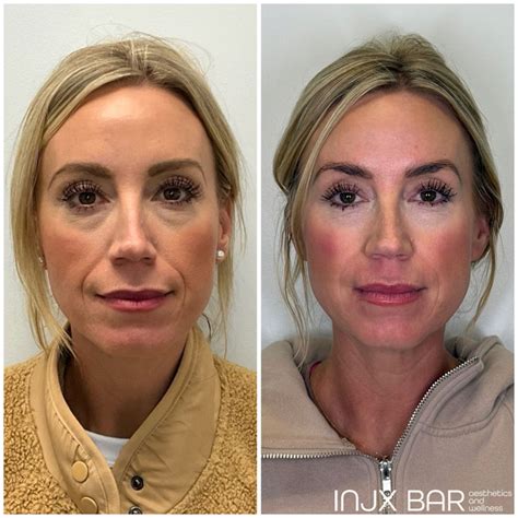 Sculptra Filler Injections: Temples, Butt Lift & More in Peoria, AZ