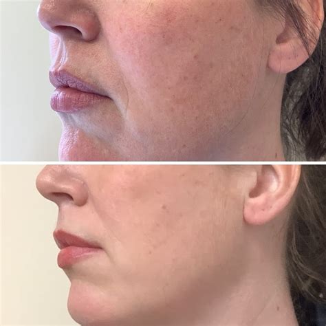 Profhilo Treatment - Pricing & Benefits | Spires Oral & Dermal Care ...