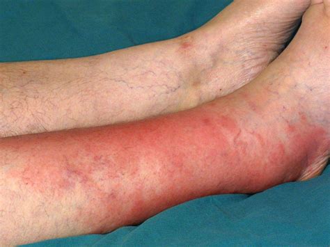 Cellulitis: Signs and Symptoms