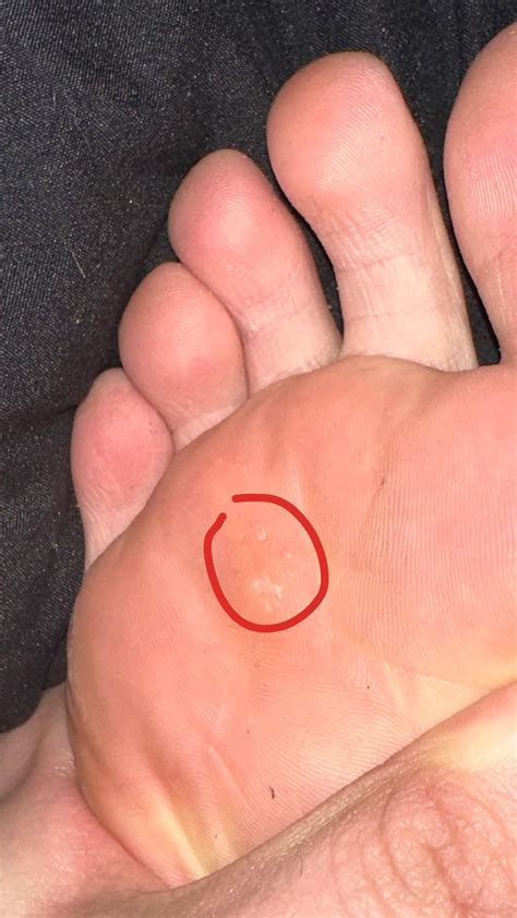 Pimple On Bottom Of Foot Sale | emergencydentistry.com