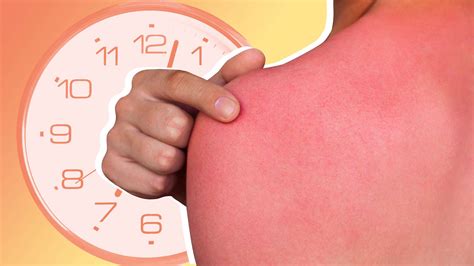 How Long Does a Sunburn Last? Experts Explain