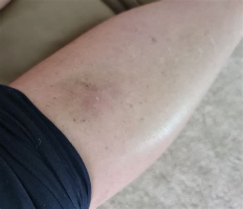 I’m a vet assistant; this is my fall collection : r/bruises
