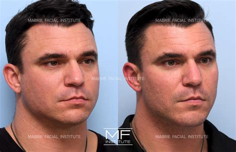 Jawline Surgery Men Before And After Chin Filler For Men Before