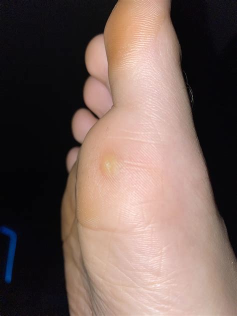 What is this little bump that has developed on my foot? : DiagnoseMe