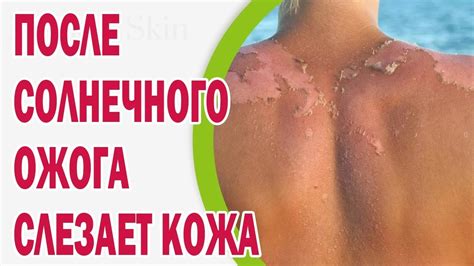 После солнечного ожога слезает кожа, что делать - YouTube