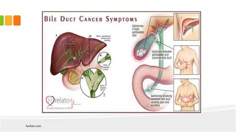 PPT - Jane Bile Duct Cancer Symptoms Aur Rahe Swasth PowerPoint Presentation - ID:7255447