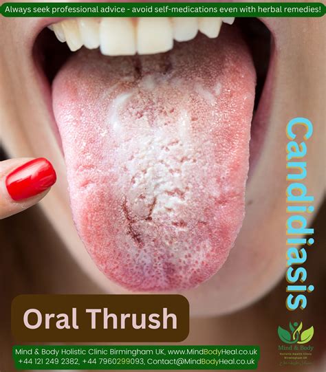 Oral Thrush Before And After