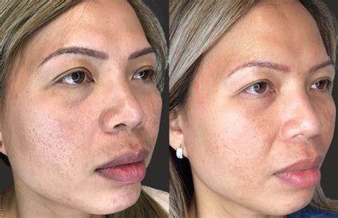Fractional Radiofrequency Microneedling NYC - All You Need To Know