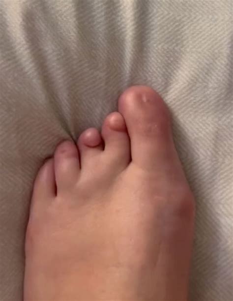 I was born without toenails — now I’m an online sensation | New York Post
