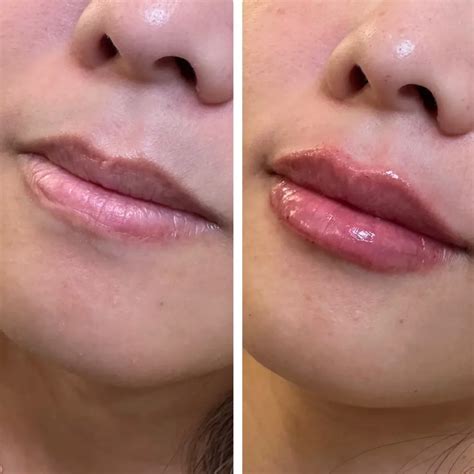 Lip Filler Before and After - Before After Journey