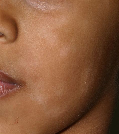 Hypopigmentation