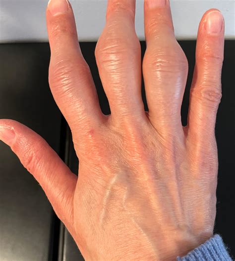 Differential Diagnosis Of Joint Pain And Swelling at Troy Cason blog