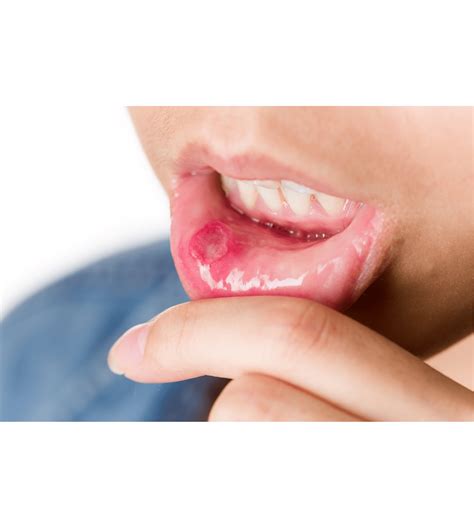 Canker Sores From Braces | Treatment, Tips, And, Tricks