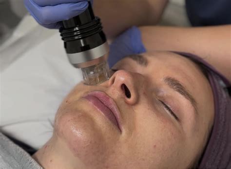 Non Cancerous Lesions Skin – Benign Growth on Skin | rtwskin