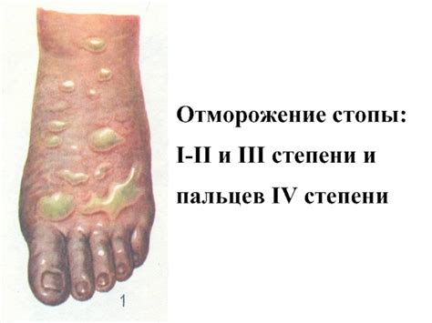 Первая помощь при обморожении и ожоге разных степеней презентация, доклад