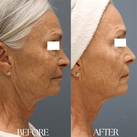RF Microneedling Before & After Results