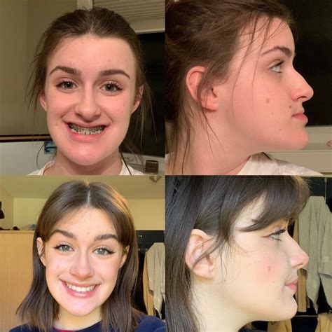 this week was officially 1 year post double jaw surgery for me! :) : r ...