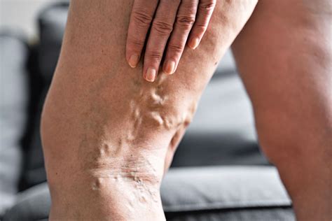 Varicose Veins Behind the Knee- Inovia Vein