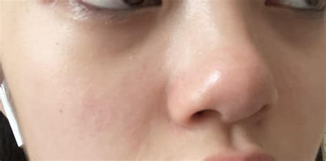 What skincare helps to get rid of this slight redness? (17F) : r/Skincare_Addiction