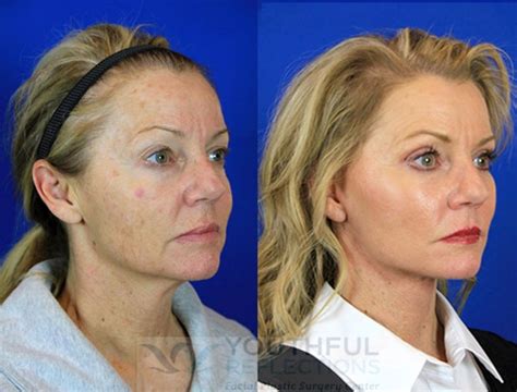 CO2 Laser Skin Resurfacing Before & After Photos Patient 95 | Nashville, TN | Youthful Reflections