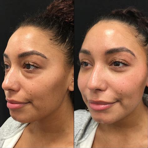 Lower Blepharoplasty Before & After Photos | Flora Levin MD