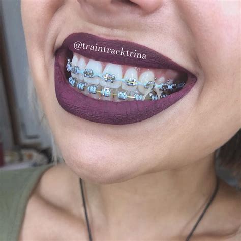 Cute braces colors - motorcyclehery
