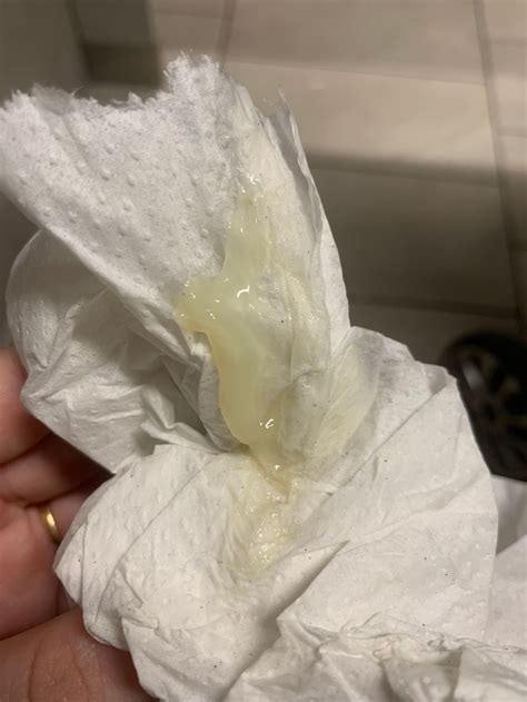 Mucus Plug Discharge