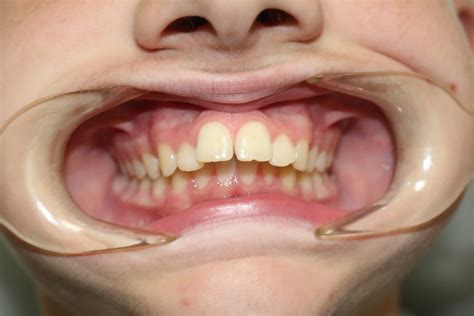 Fixing Buck Teeth: Your Guide to Treatment Options and a Healthier ...