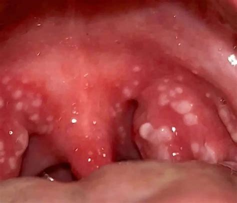 Common Strep Throat Symptoms You Should Know | Credihealth