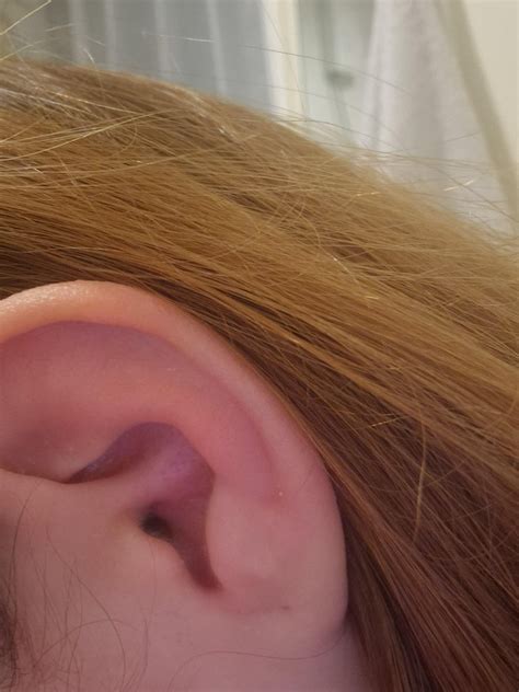 Bump On Ear Cartilage