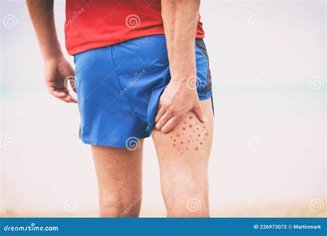 Body Acne Man Scratching Itchy Pimples on Back Leg Thigh -skin Allergy To Poison Ivy Plant ...