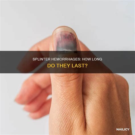Splinter Hemorrhages: How Long Do They Last? | Nailicy
