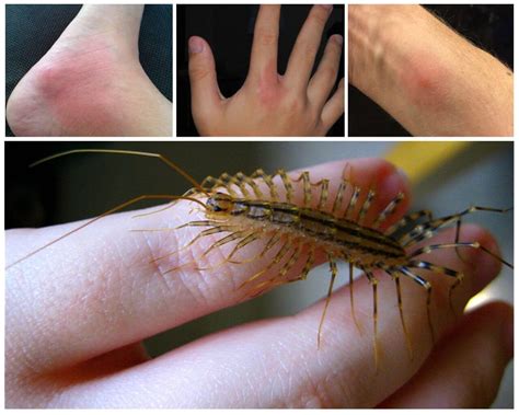 Bite Of Centipede