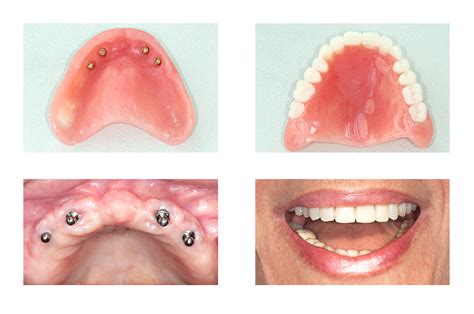 Dental Implants Dentures