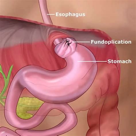 Postcholecystectomy Syndrome | LSDC Healthcare
