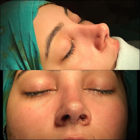 😍😍😍😍😍😍👃fındık burun | nose job | rhinoplasty | button nose #rinoplasti#rhinoplasty#nose#nosejob# ...