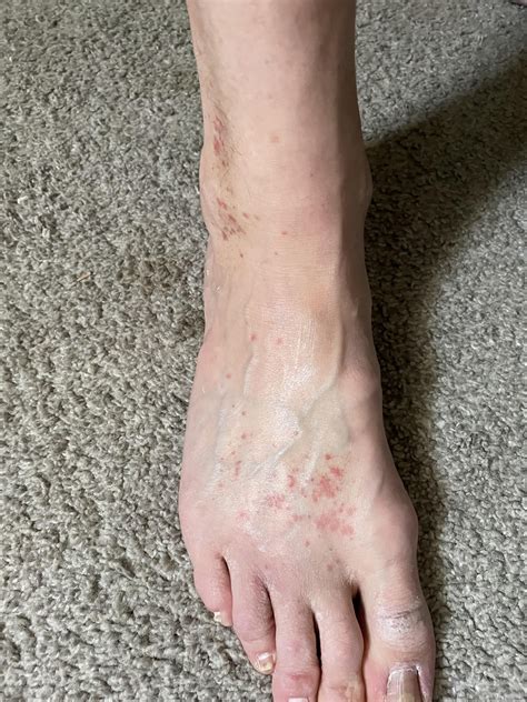 Rash or fungus on tops of feet and ankles. Some on leg above ankle. : r ...