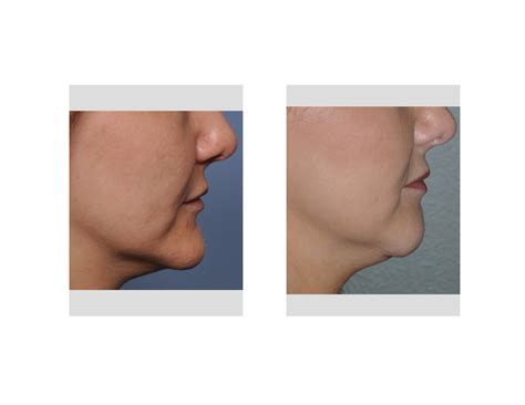 Chin Reduction Surgery Female