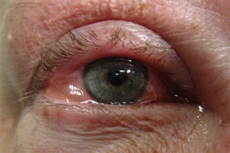 Allergic eye disease: itching to know more?