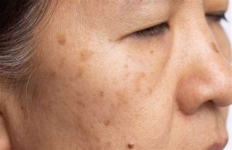 Melasma/Pigmentation — Dr Shreya Andric | Northern Sydney Dermatologist