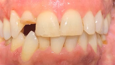 Root Canal Front Tooth A Failed Root Canal On A Front Tooth Led To An