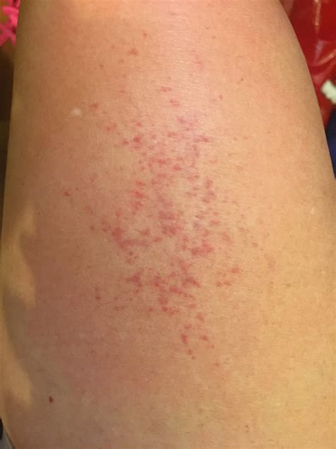 Every time I scratch, this is what happens and my skin is hot to the touch. Since I itch ...