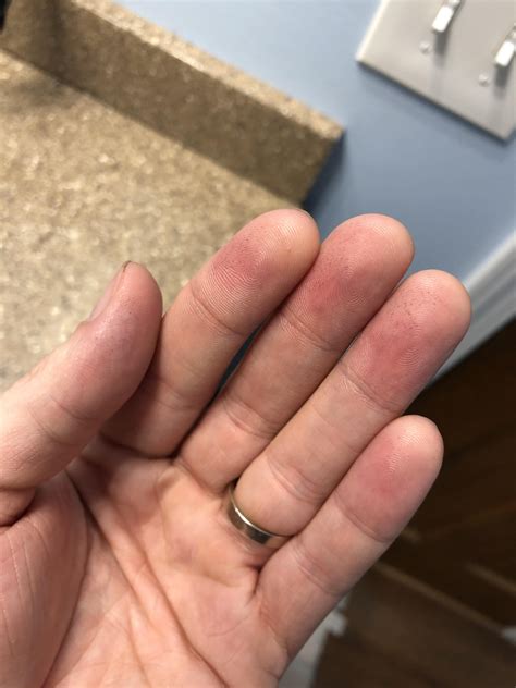 What are these small black dots that appear on my left hand fingertips ...