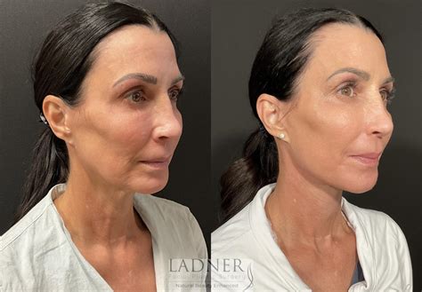 Deep Plane Facelift / Neck Lift Before and After Pictures Case 241 | Denver, CO | Ladner Facial ...